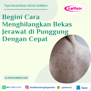 Cara Mengatasi Jerawat Punggung