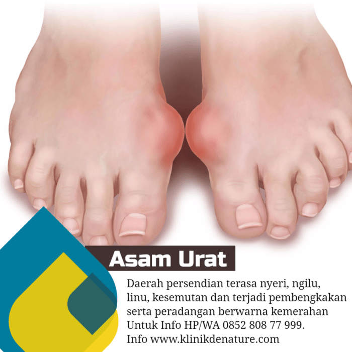 Cara Mengatasi Asam Urat